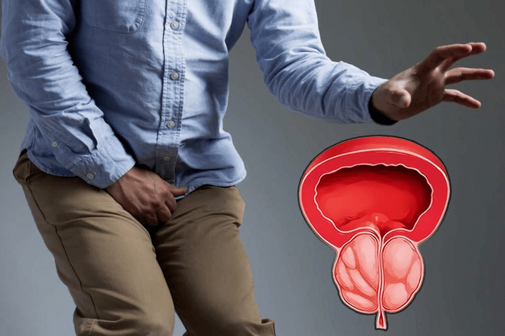 prostatite e il suo trattamento con le capsule Weiprost